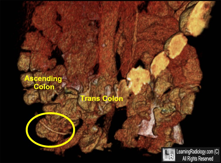 perforation bowel from chicken bone
